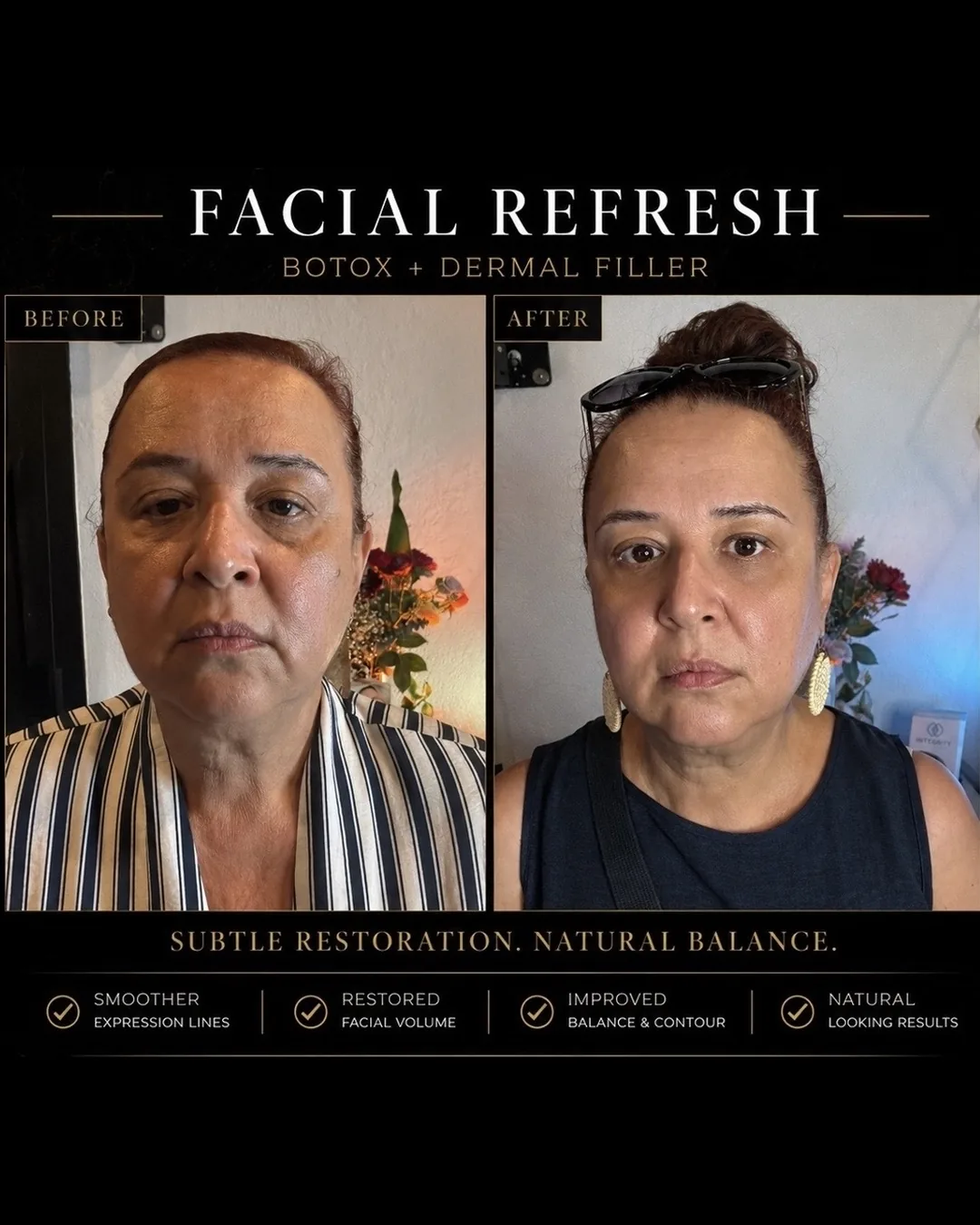 Before and after — facial refresh with Botox and dermal filler
